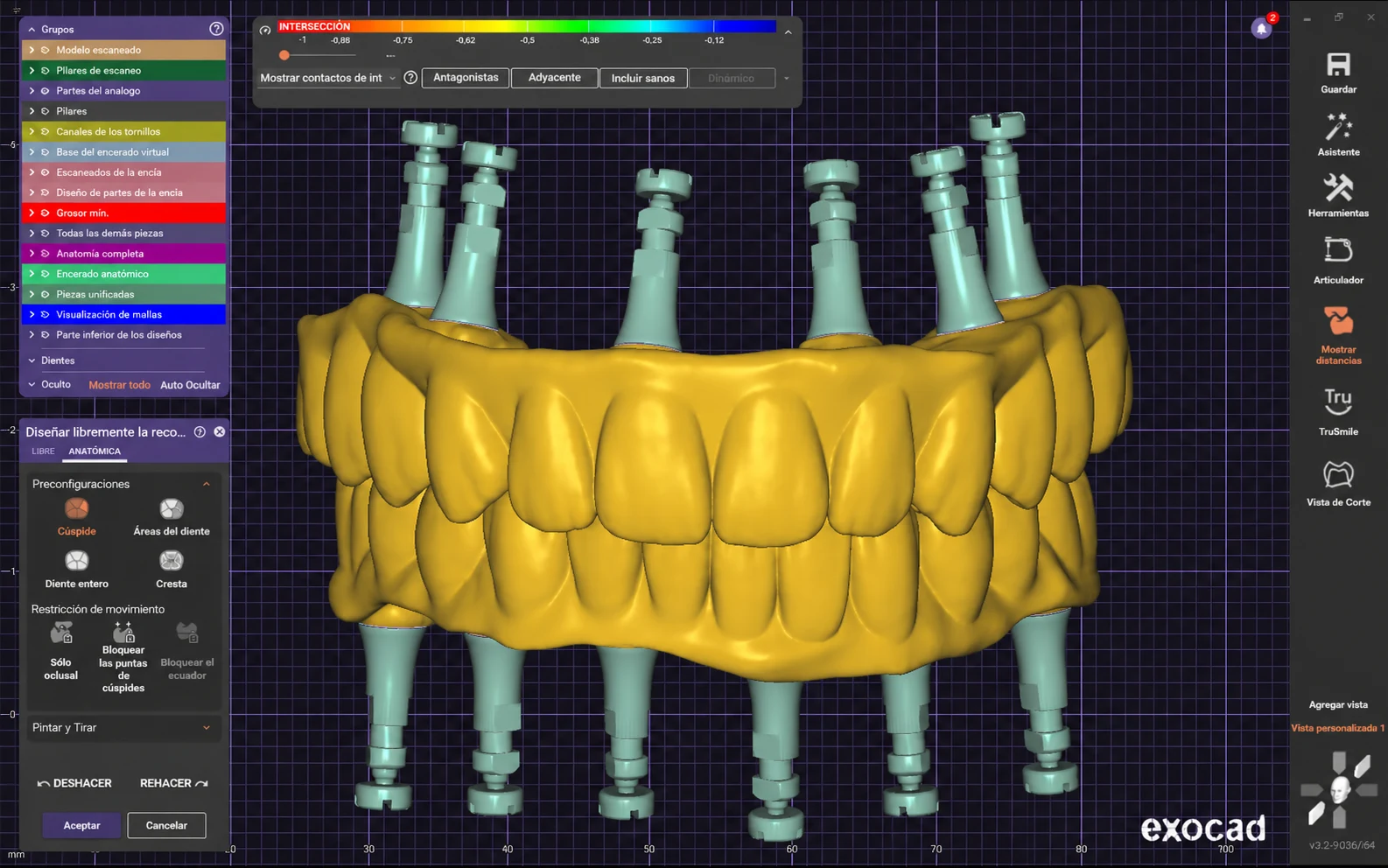 Planificación digital CAD/CAM con software exocad en laboratorio dental Digitalis Málaga